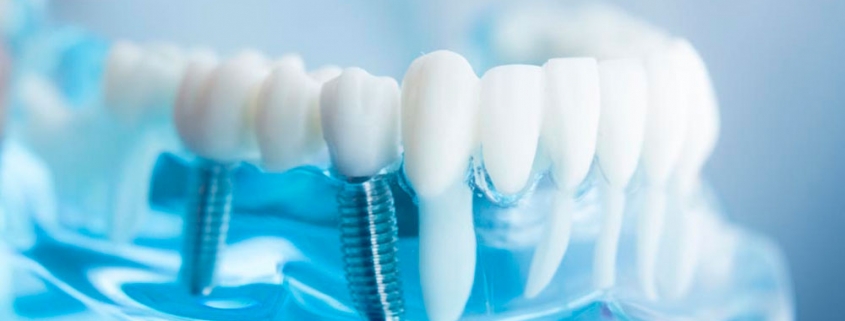 Benefícios do Implante Dentário
