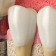 Implantes Dentários