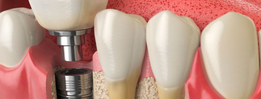 Implantes Dentários