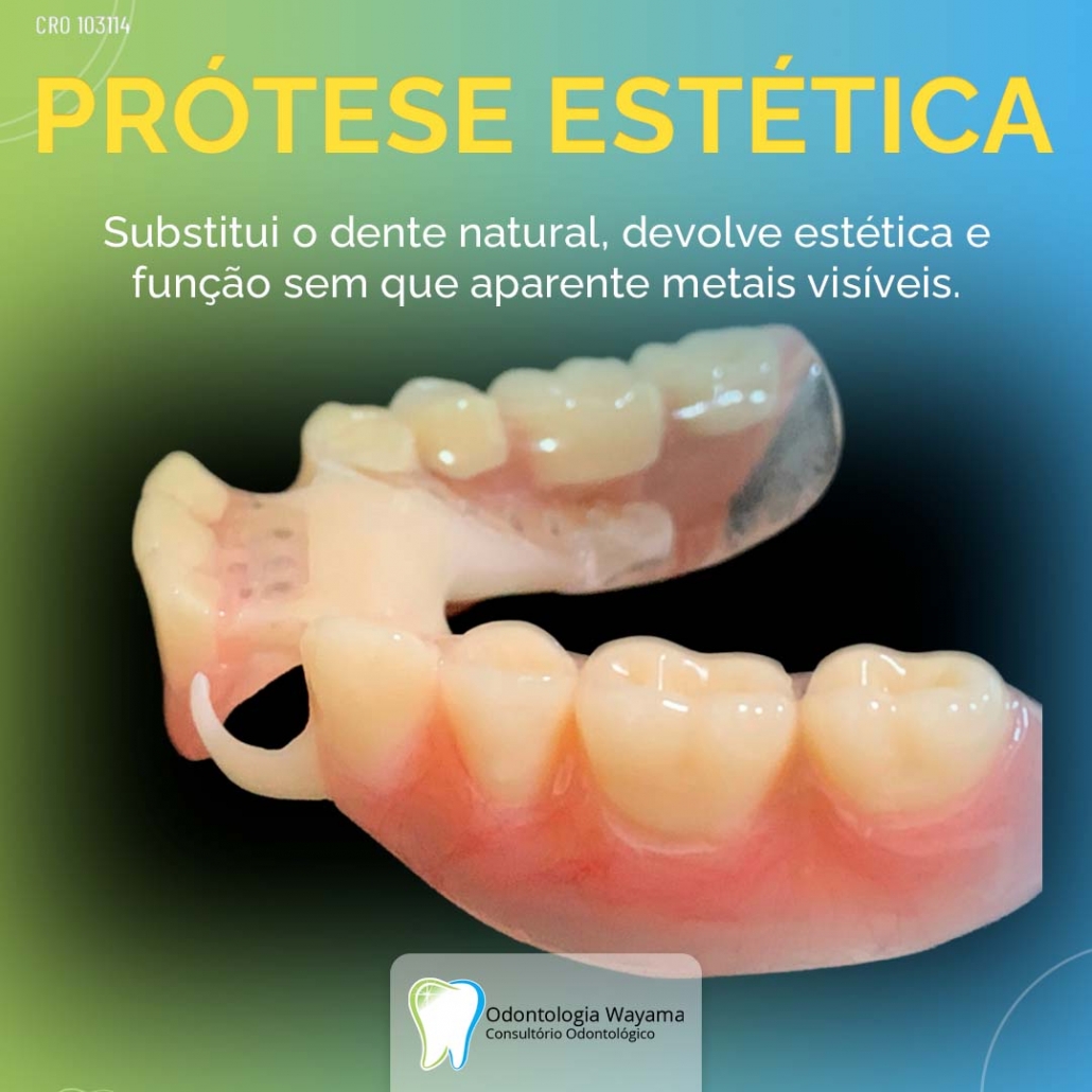 Conheça 4 tipos de prótese - Dr. Marcelo Wayama